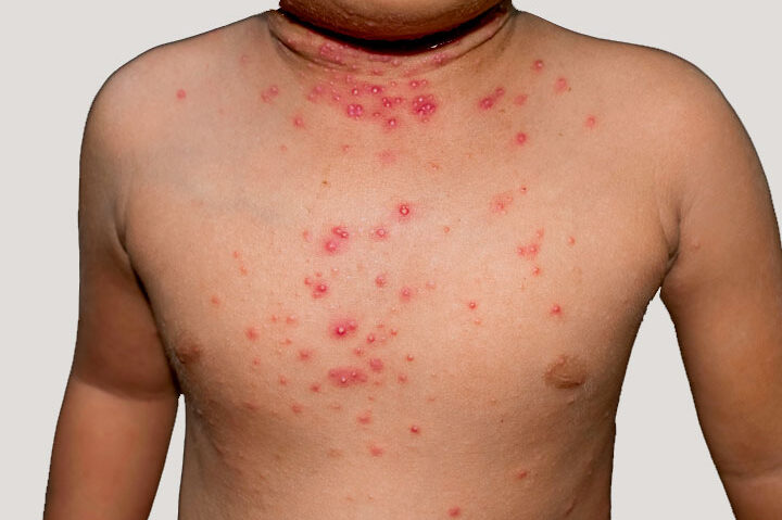 sarpullidos virales en la infancia