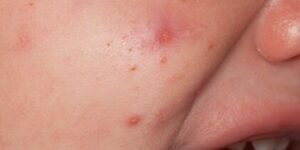 tipos de sarpullidos en bebes