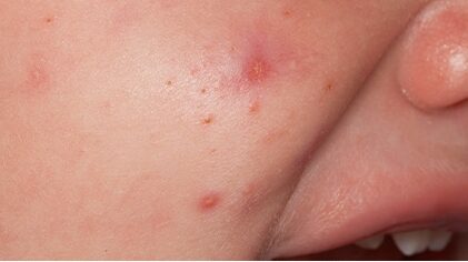 tipos de sarpullidos en bebes