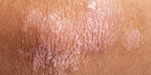causas y prevencion de la psoriasis