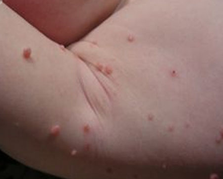 consejos para tratar molusco contagioso en ninos