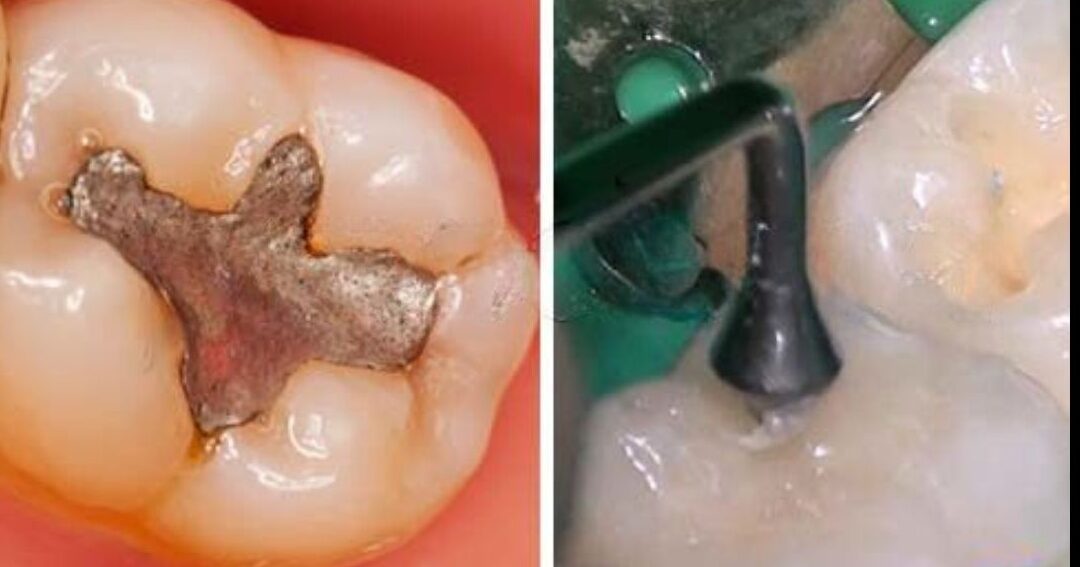 diferencias entre empastes de resina