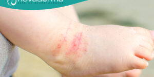 enfermedades cutaneas en la ninez