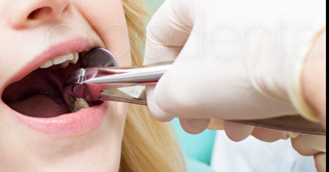 extraccion dental en ninos