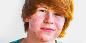 impacto psicologico del acne en ninos