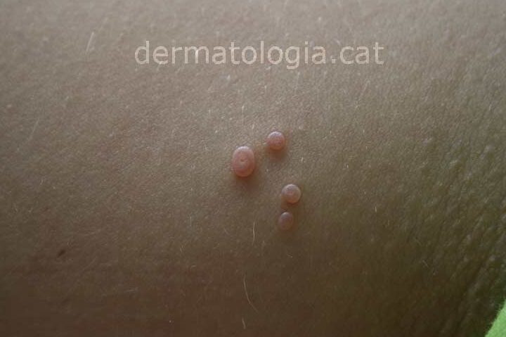 molusco contagioso en dermatologia infantil