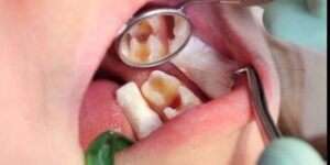 sintomas y tratamientos de pulpitis en ninos
