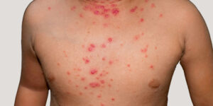 tipos de alergias cutaneas en la infancia