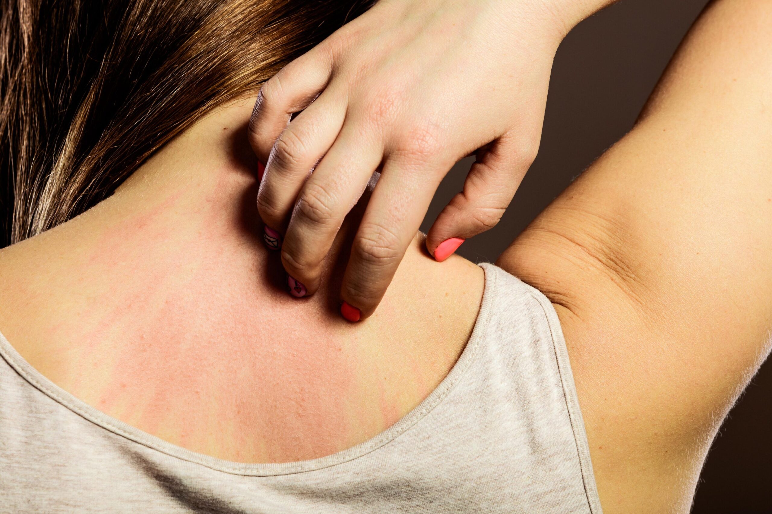 sintomas y tratamientos dermatologicos pedijson